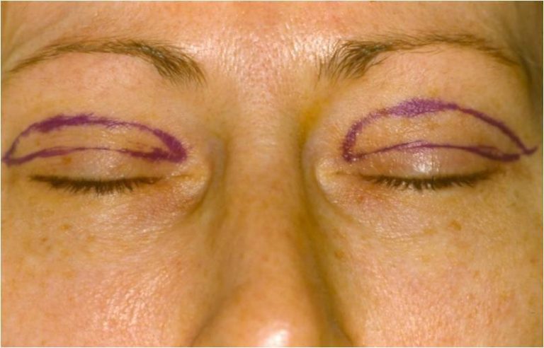 upper-eyelid-surgery-evans-augusta-georgia-blepharoplasty