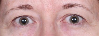 Evans Upper Eyelid Surgery by Dr. Marc Polacco | The Georgia Center